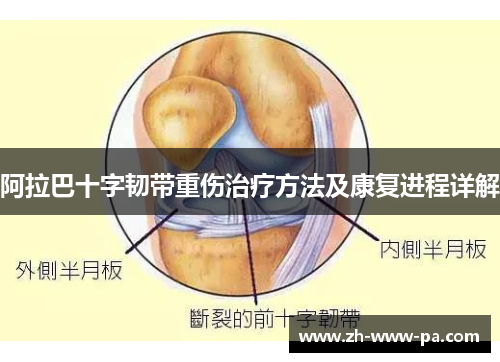 阿拉巴十字韧带重伤治疗方法及康复进程详解 阿拉巴十字韧带重伤治疗方法及康复进程详解